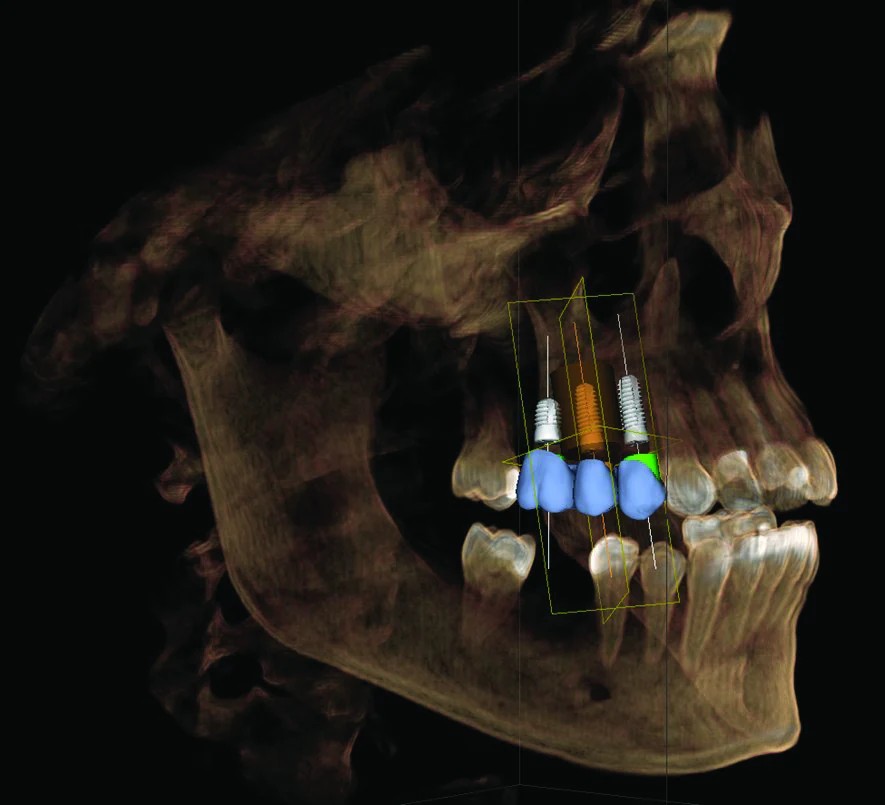 Computer-guided implant planning