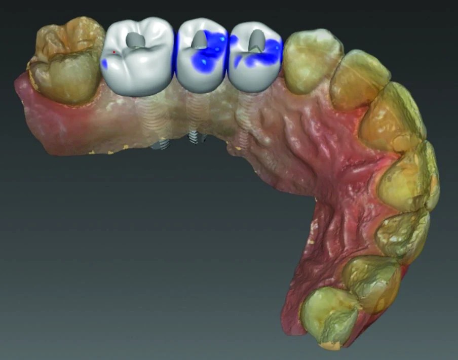 Custom restorative design at Enzo Dentistry